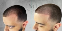 Pattern Baldness