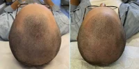 Restore Hairline